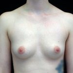 Breast Augmentation (Fat Transfer) Before & After Patient #17011