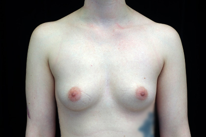 Breast Augmentation (Fat Transfer) Before & After Patient #17011