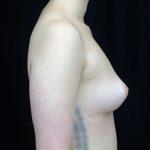 Breast Augmentation (Fat Transfer) Before & After Patient #17011