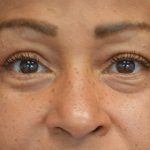 Blepharoplasty Before & After Patient #16995