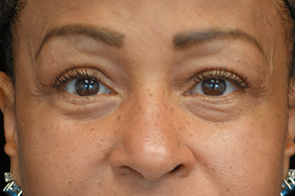 Blepharoplasty Before & After Patient #16995
