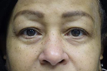 Blepharoplasty Before & After Patient #16995