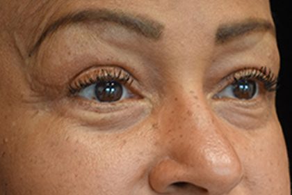 Blepharoplasty Before & After Patient #16995