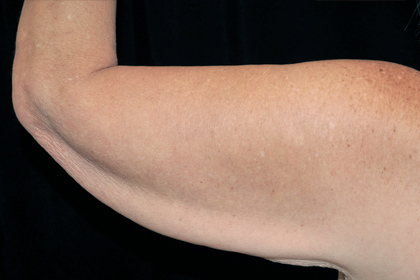 Brachioplasty Before & After Patient #16909