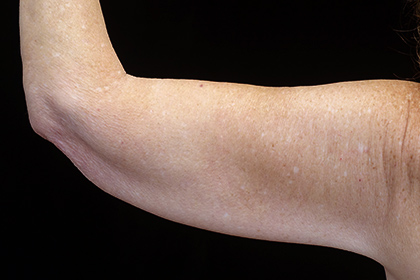 Brachioplasty Before & After Patient #16909