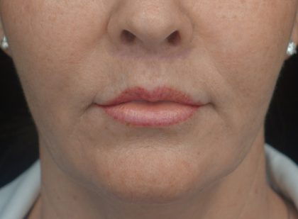 Lip Lift Before & After Patient #17000