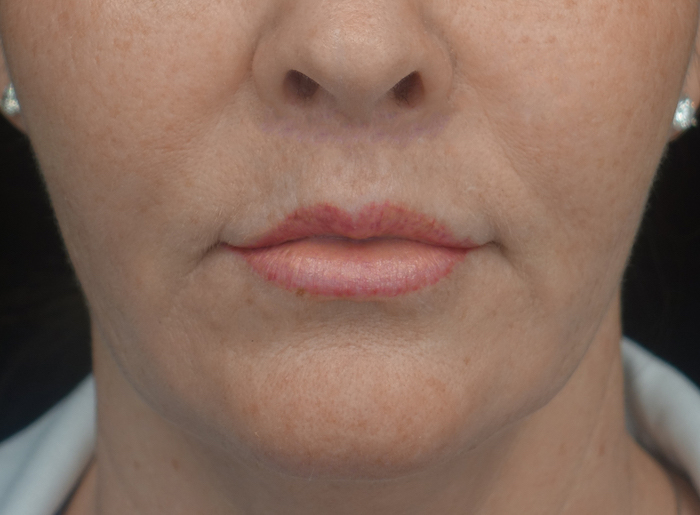 Lip Lift Before & After Patient #17000