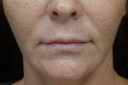 Lip Lift Before & After Patient #17000