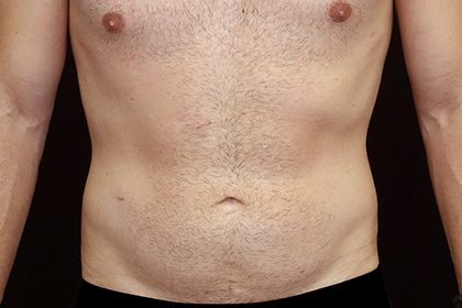 Liposuction Before & After Patient #17003