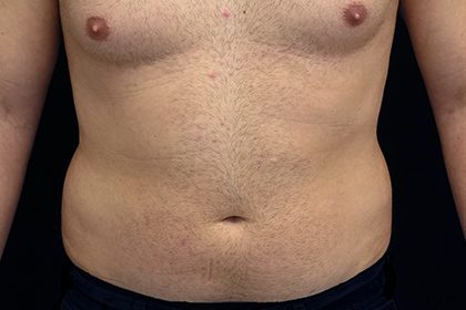 Liposuction Before & After Patient #17003