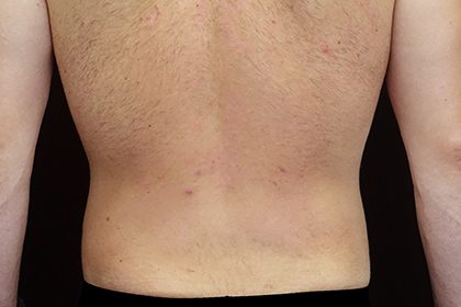 Liposuction Before & After Patient #17003