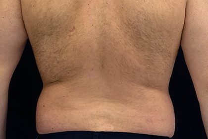 Liposuction Before & After Patient #17003