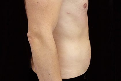 Liposuction Before & After Patient #17003