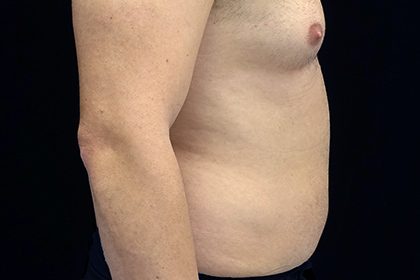 Liposuction Before & After Patient #17003
