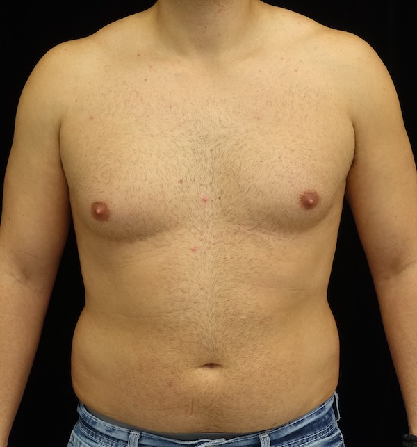 Liposuction Before & After Patient #17003
