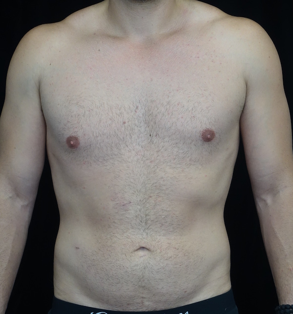 Liposuction Before & After Patient #17003