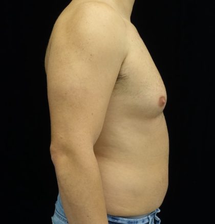 Liposuction Before & After Patient #17003