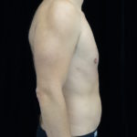 Liposuction Before & After Patient #17003