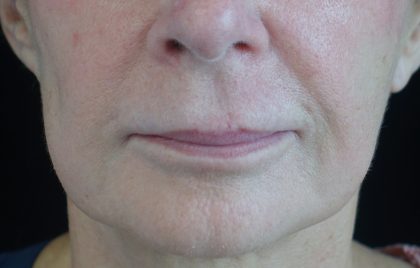 Lip Lift Before & After Patient #17142