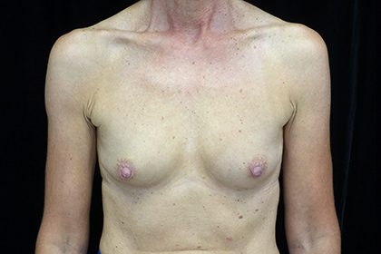 Breast Augmentation (Implants) Before & After Patient #17185