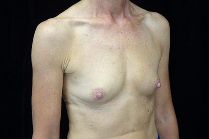 Breast Augmentation (Implants) Before & After Patient #17185