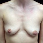 Breast Augmentation (Implants) Before & After Patient #17164