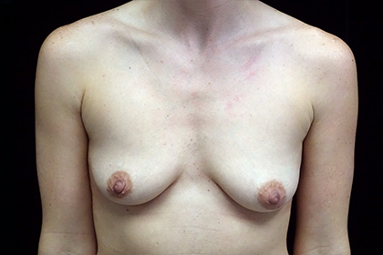 Breast Augmentation (Implants) Before & After Patient #17164