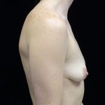 Breast Augmentation (Implants) Before & After Patient #17164