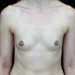 Breast Augmentation (Implants) Before & After Patient #17171
