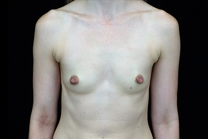 Breast Augmentation (Implants) Before & After Patient #17171