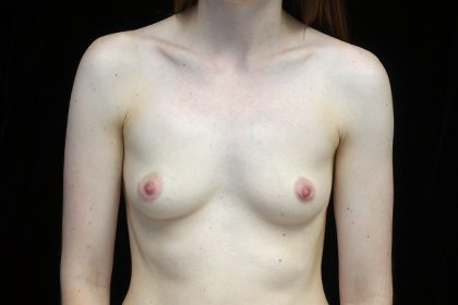 Breast Augmentation (Implants) Before & After Patient #17178