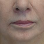 Lip Lift Before & After Patient #17142