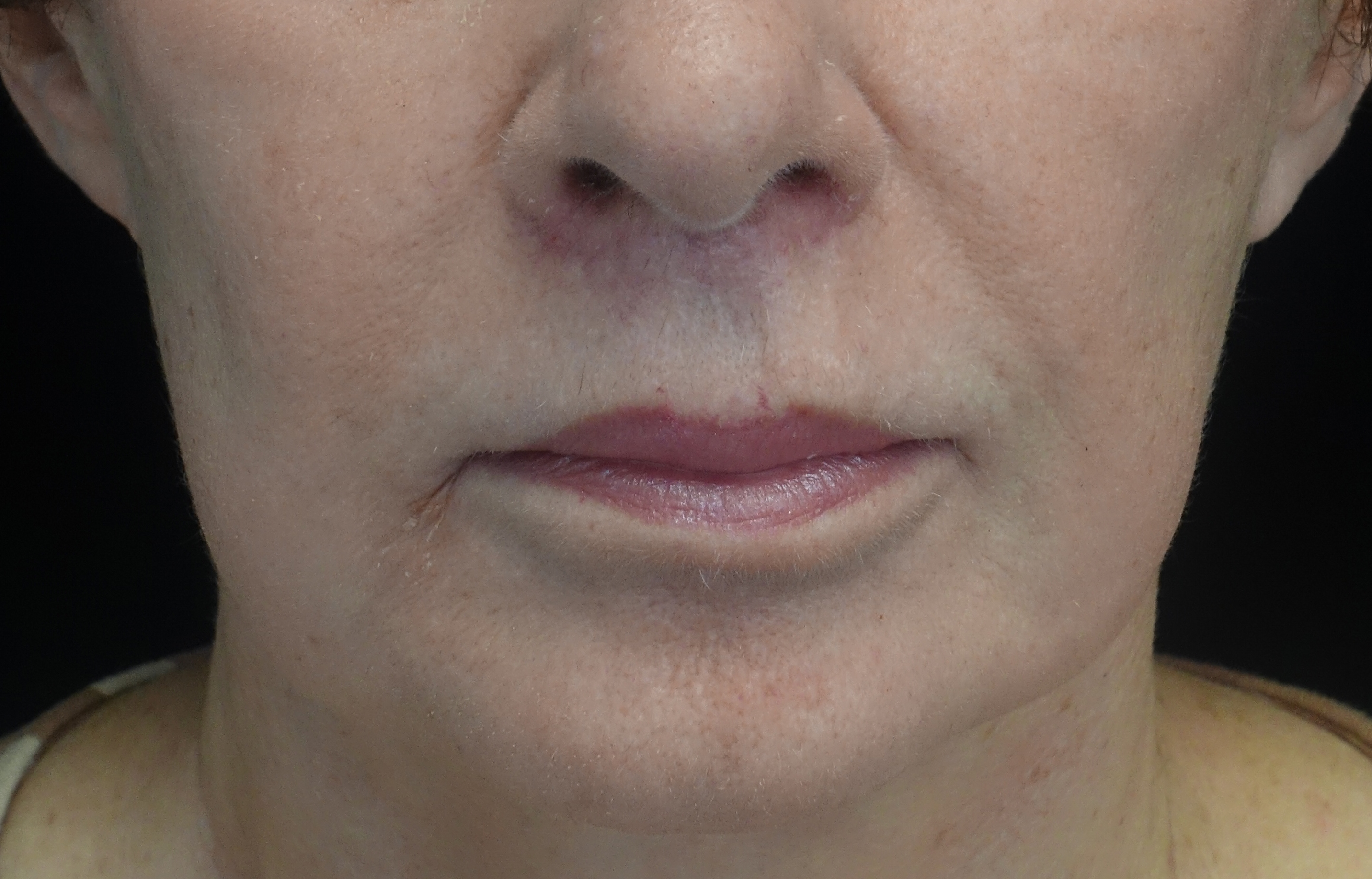 Lip Lift Before & After Patient #17142