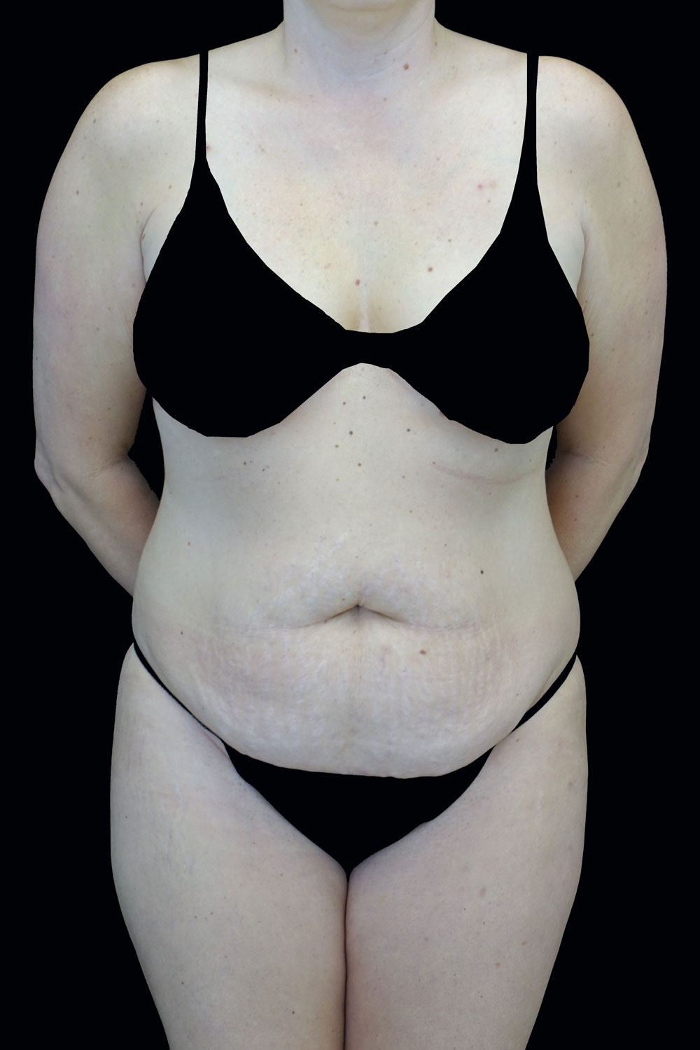 Lipoabdominoplasty Before & After Patient #17375