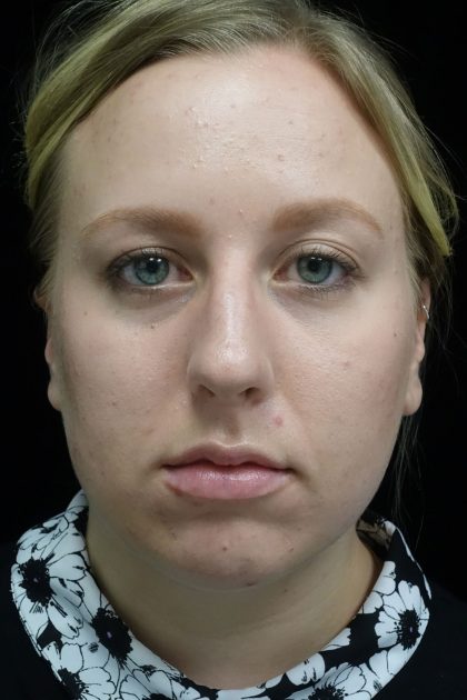 Rhinoplasty Before & After Patient #17409