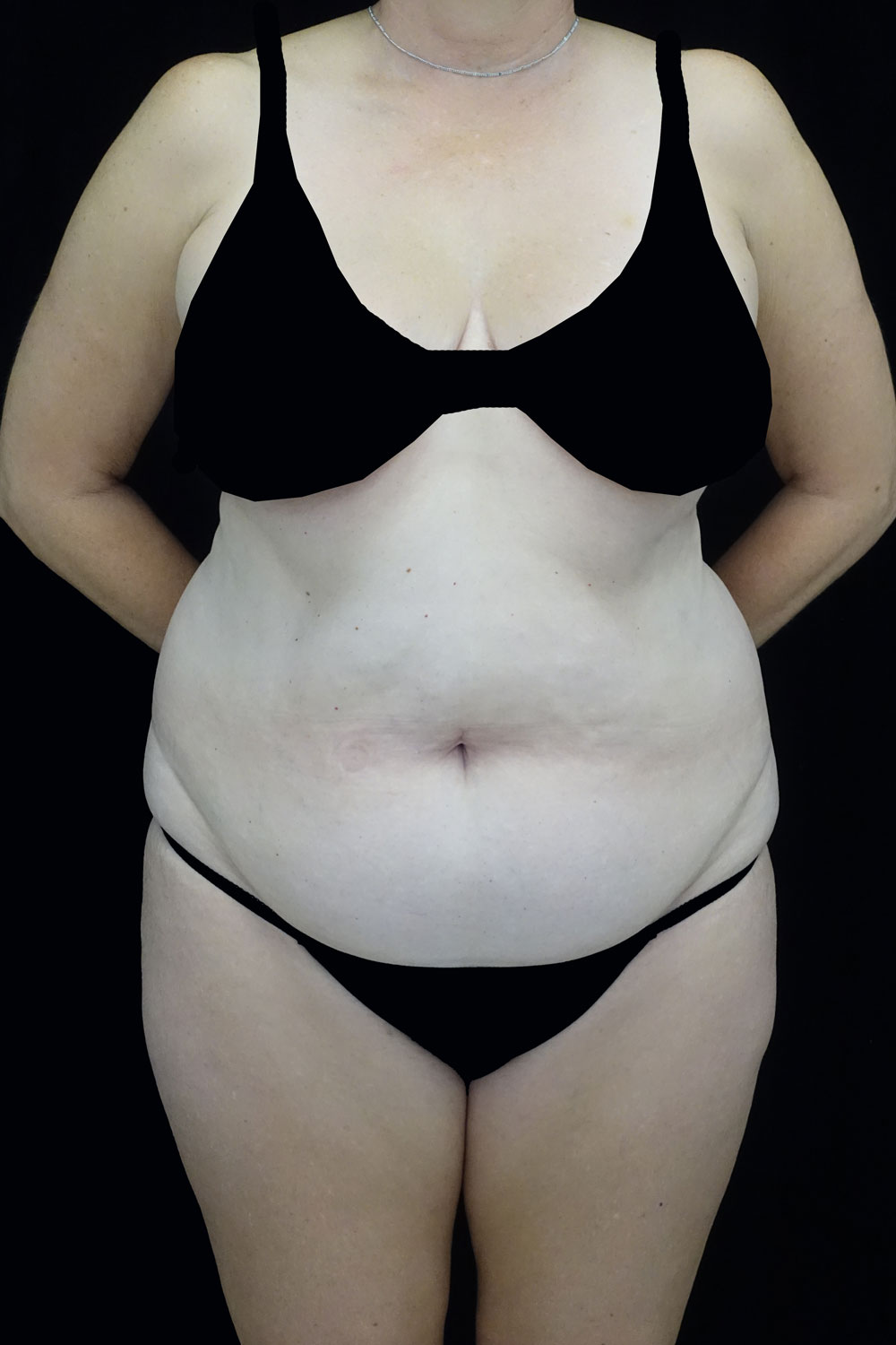 Lipoabdominoplasty Before & After Patient #17361