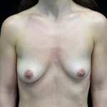 Asymmetric Tuberous Breasts Before & After Patient #17277
