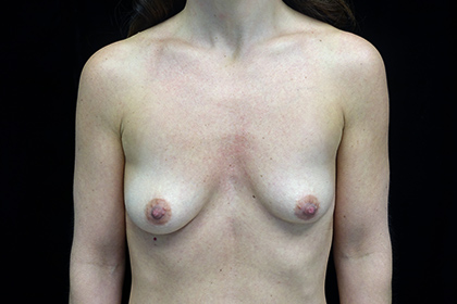 Asymmetric Tuberous Breasts Before & After Patient #17277