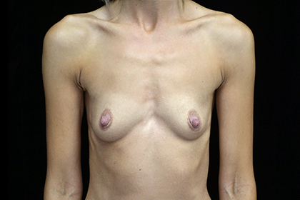 Breast Augmentation (Implants) Before & After Patient #17291