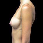 Breast Augmentation (Implants) Before & After Patient #17291