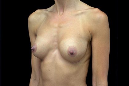 Breast Augmentation (Implants) Before & After Patient #17291