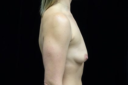 Breast Augmentation (Implants) Before & After Patient #17305