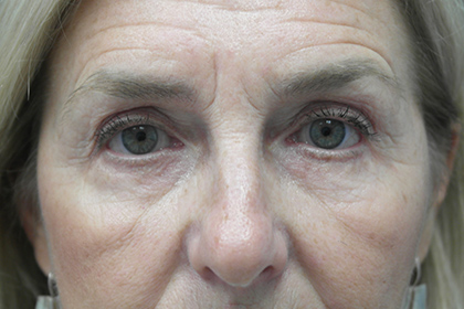 Blepharoplasty Before & After Patient #17284