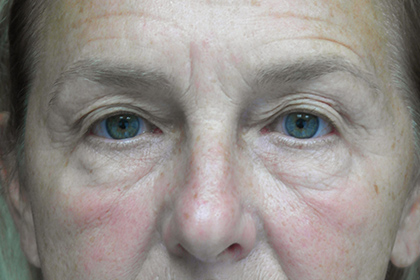 Blepharoplasty Before & After Patient #17284