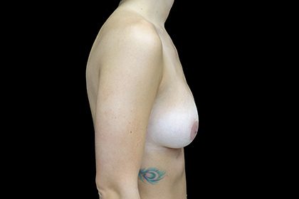 Breast Reduction Before & After Patient #17312
