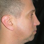 Chin Implants (Augmentation) Before & After Patient #17257