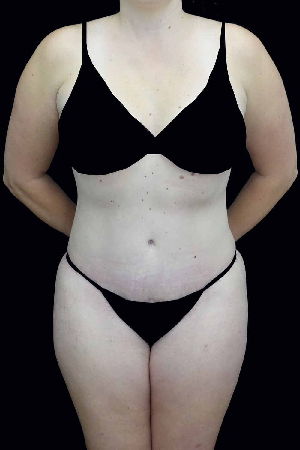 Lipoabdominoplasty Before & After Patient #17375