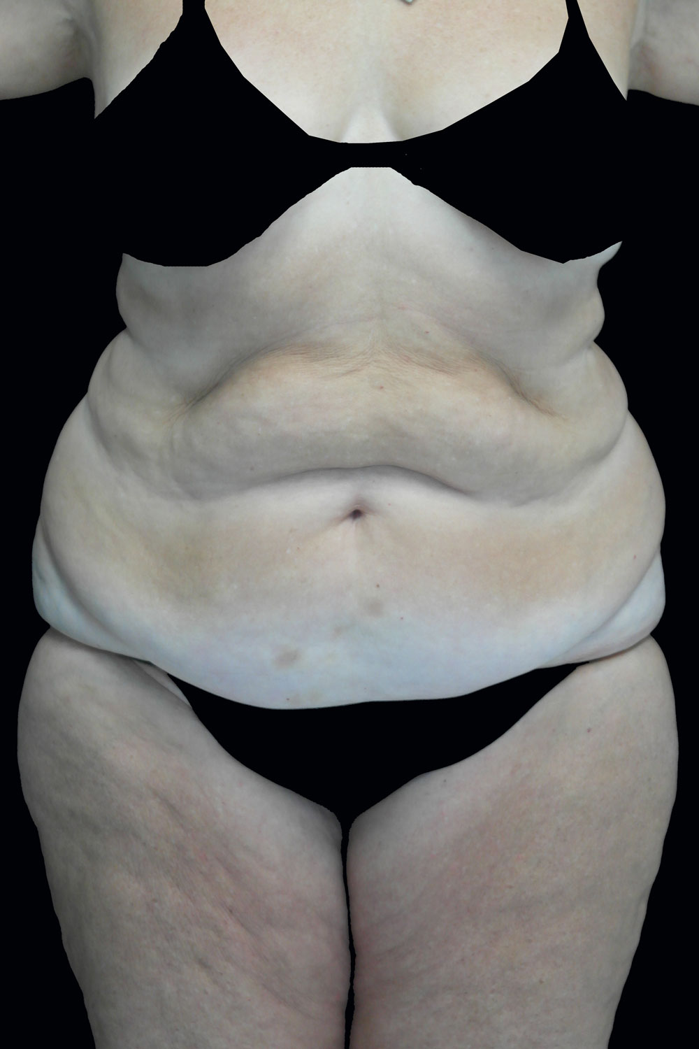 Lipoabdominoplasty Before & After Patient #17368