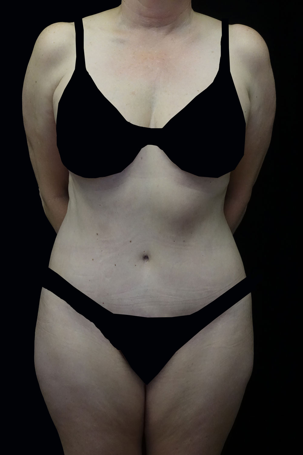 Lipoabdominoplasty Before & After Patient #17361