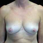 Breast Augmentation (Fat Transfer) Before & After Patient #17319